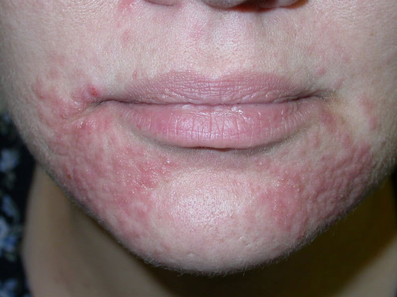 When is acne not acne? When it’s perioral dermatitis…