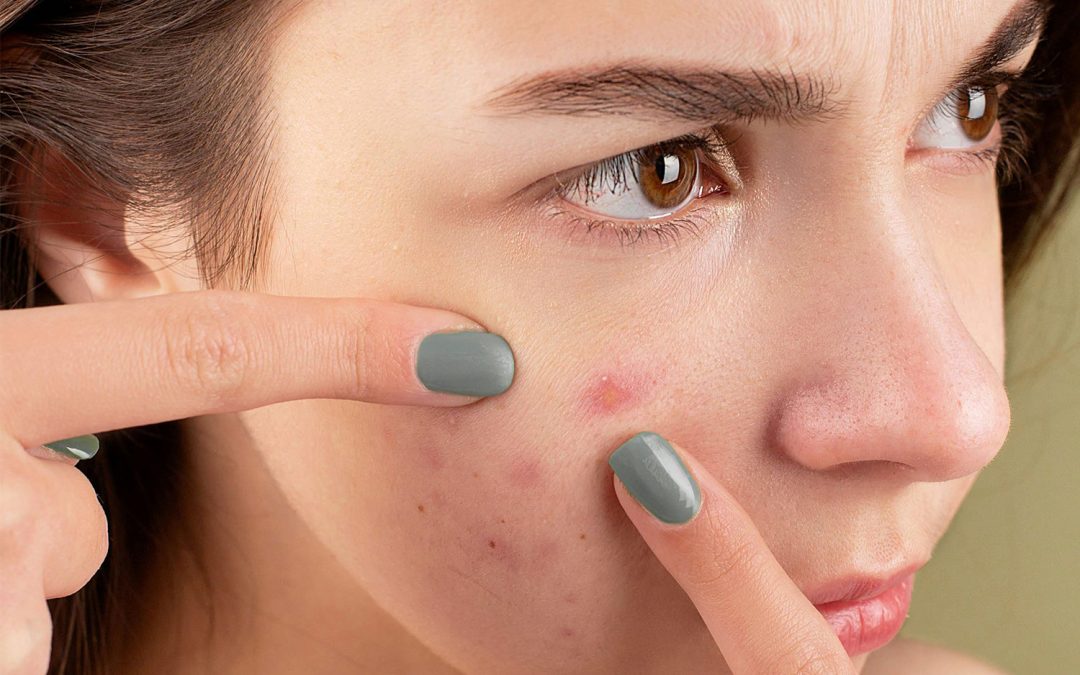 5 Things Every Acne Patient Should Know…