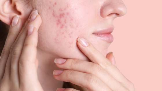 Why a Late Period Can Trigger More Breakouts (And the Hormone Pathway Behind It)