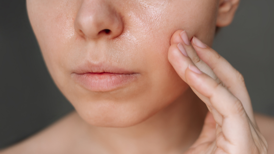 Why Is My Skin So Oily? The Real Reason Behind Excess Sebum and Acne